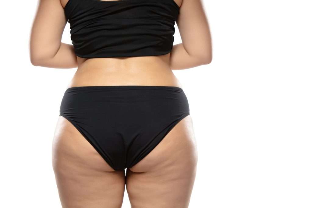เซลลูไลท์-Cellulite