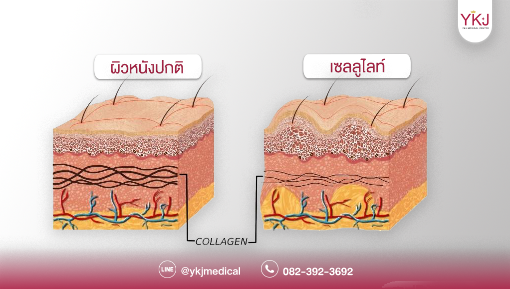 เซลลูไลท์-Cellulite