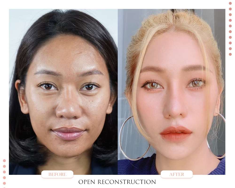 ปีกจมูกบาน-flaring nostrils