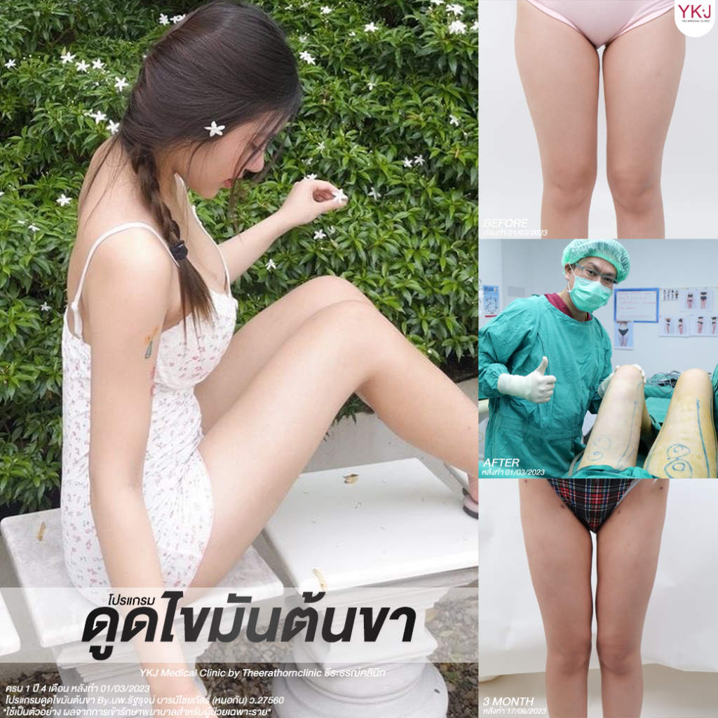 ดูดไขมัน-Liposuction