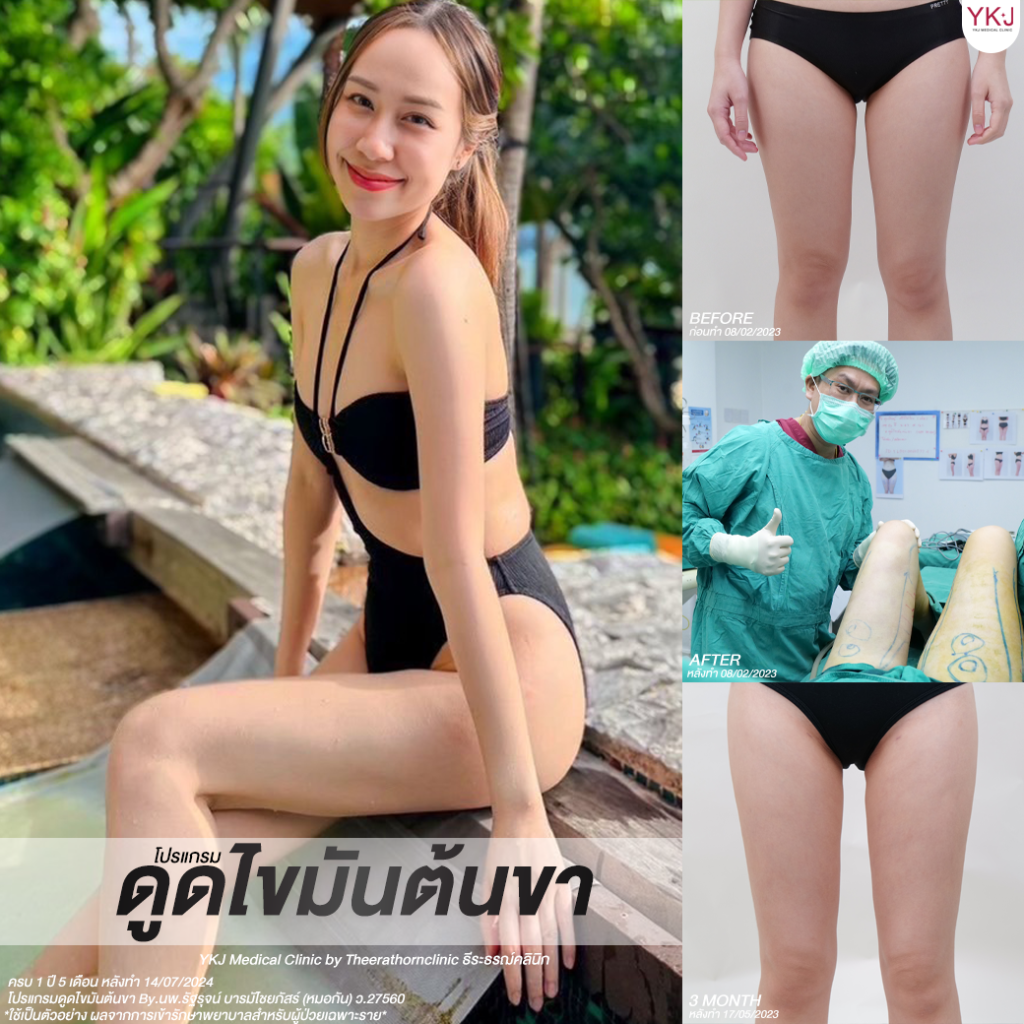 ดูดไขมัน-Liposuction