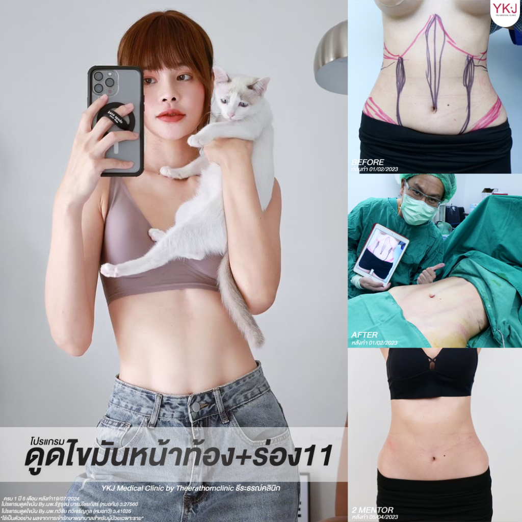 ดูดไขมัน-Liposuction