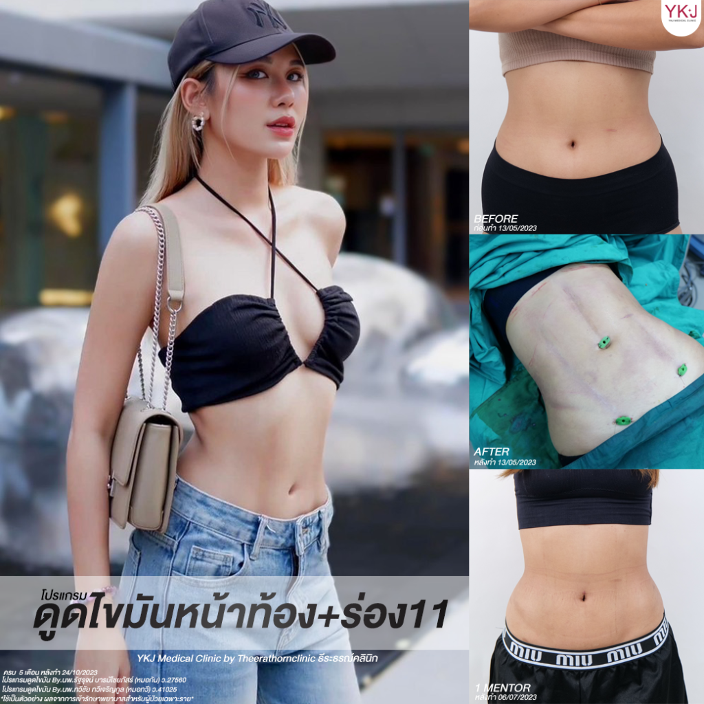 ดูดไขมัน-Liposuction