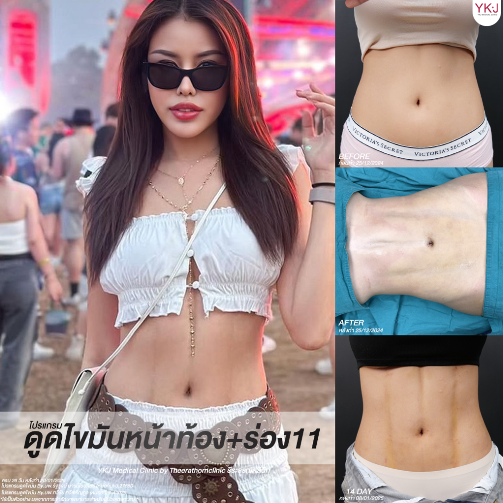 ดูดไขมัน-Liposuction