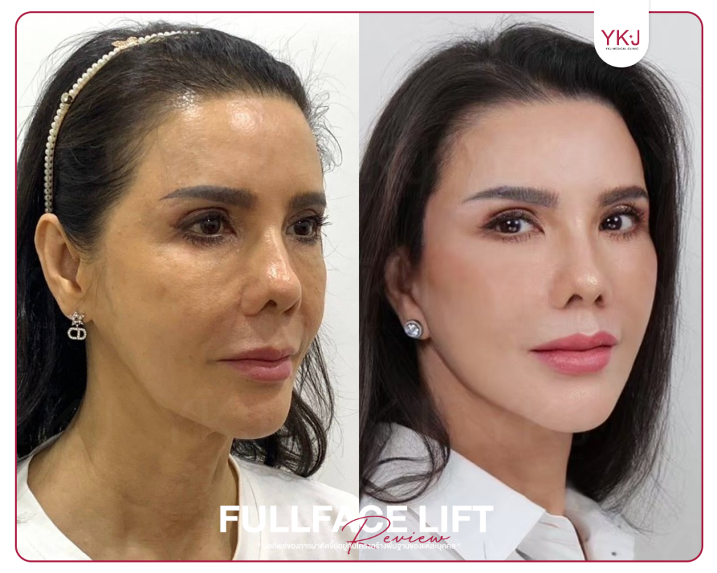 ดึงหน้า-Mini Lift-Full Facelift
