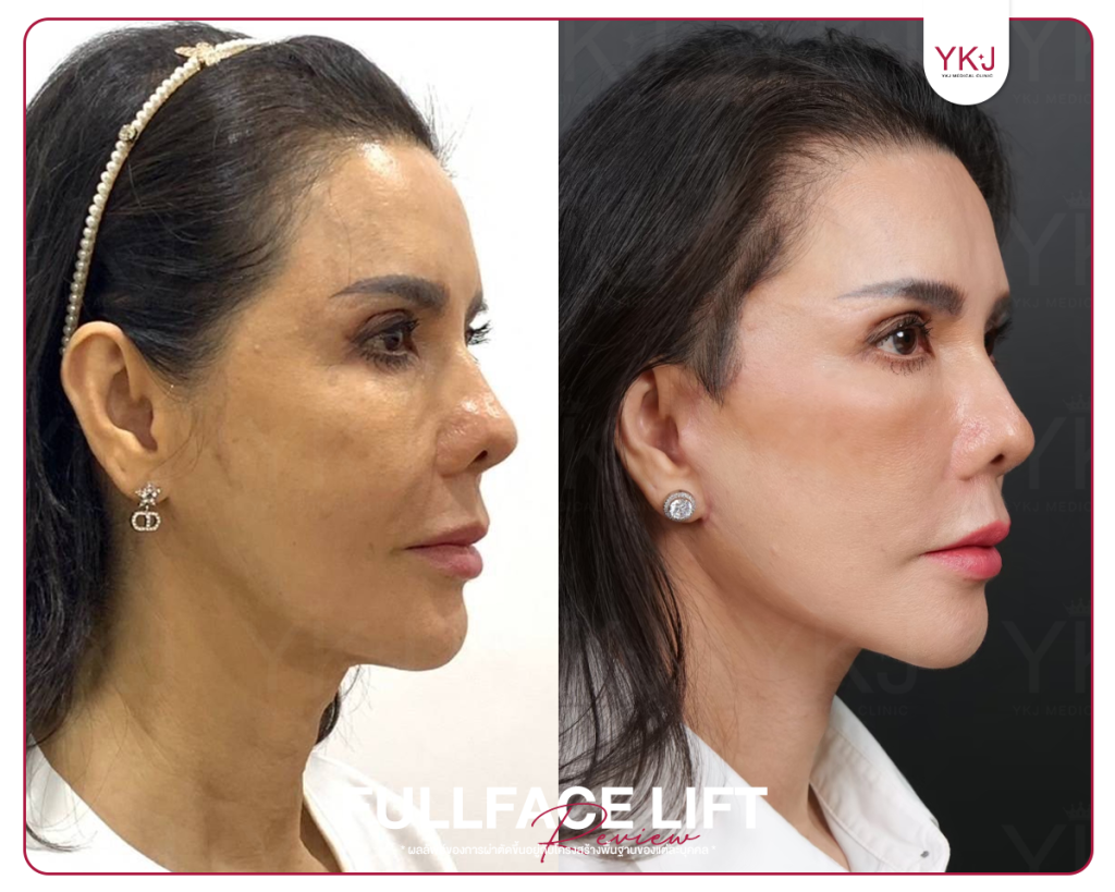 ดึงหน้า-Mini Lift-Full Facelift