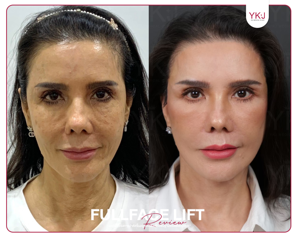 ดึงหน้า-Mini Lift-Full Facelift