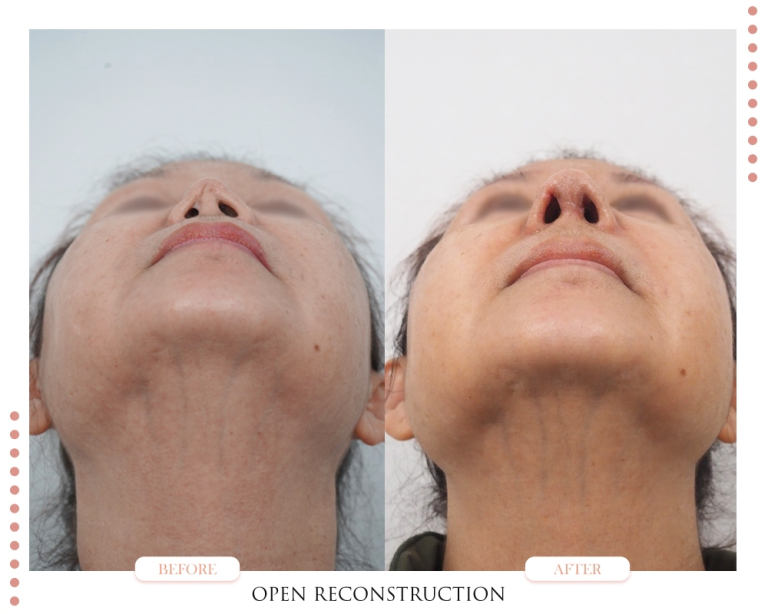 รอยบุ๋มจมูก-Nasal Indentations