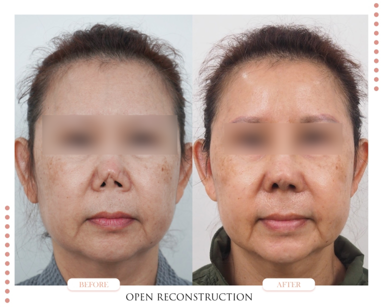 รอยบุ๋มจมูก-Nasal Indentations