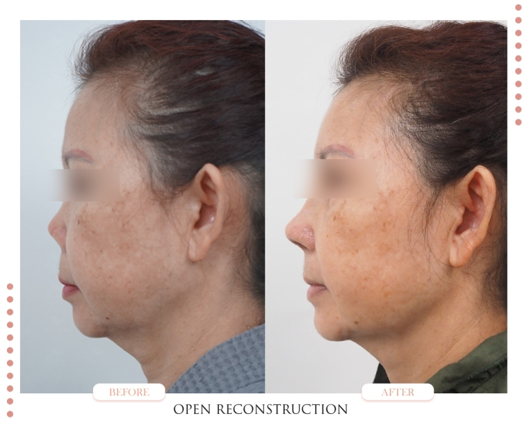 รอยบุ๋มจมูก-Nasal Indentations