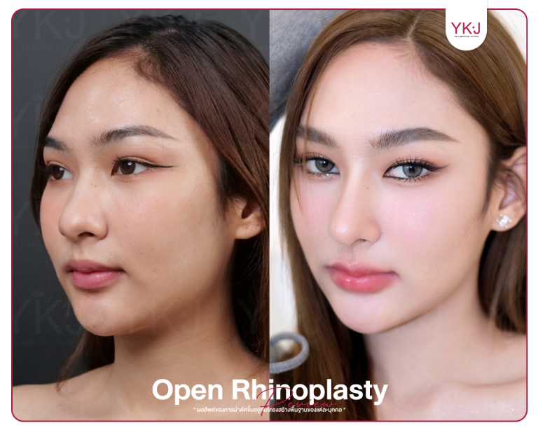 รีวิวแก้จมูก , รีวิวเสริมจมูกโอเพ่น , กระดูกซี่โครง , กระดูกอ่อนหลังหู