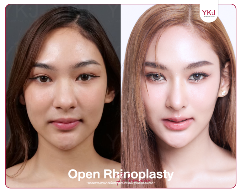 รีวิวแก้จมูก , รีวิวเสริมจมูกโอเพ่น , กระดูกซี่โครง , กระดูกอ่อนหลังหู