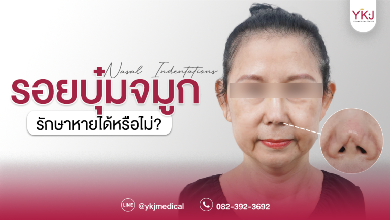 รอยบุ๋มจมูก-Nasal Indentations