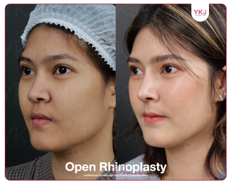 รีวิวแก้จมูก , รีวิวเสริมจมูกโอเพ่น , กระดูกซี่โครง , กระดูกอ่อนหลังหู