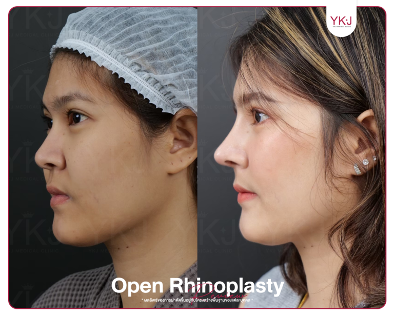 รีวิวแก้จมูก , รีวิวเสริมจมูกโอเพ่น , กระดูกซี่โครง , กระดูกอ่อนหลังหู