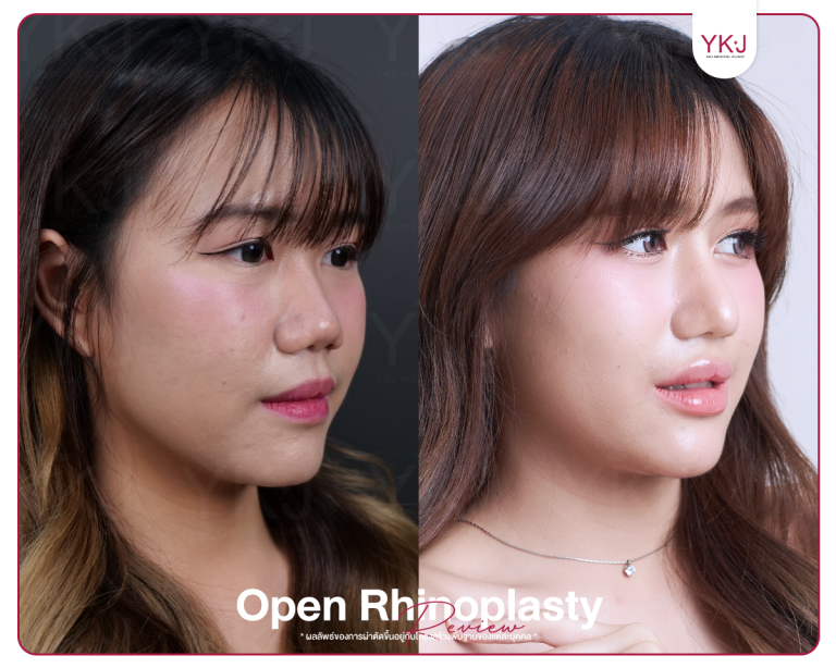 รีวิวแก้จมูก , รีวิวเสริมจมูกโอเพ่น , กระดูกซี่โครง , กระดูกอ่อนหลังหู