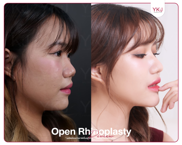 รีวิวแก้จมูก , รีวิวเสริมจมูกโอเพ่น , กระดูกซี่โครง , กระดูกอ่อนหลังหู