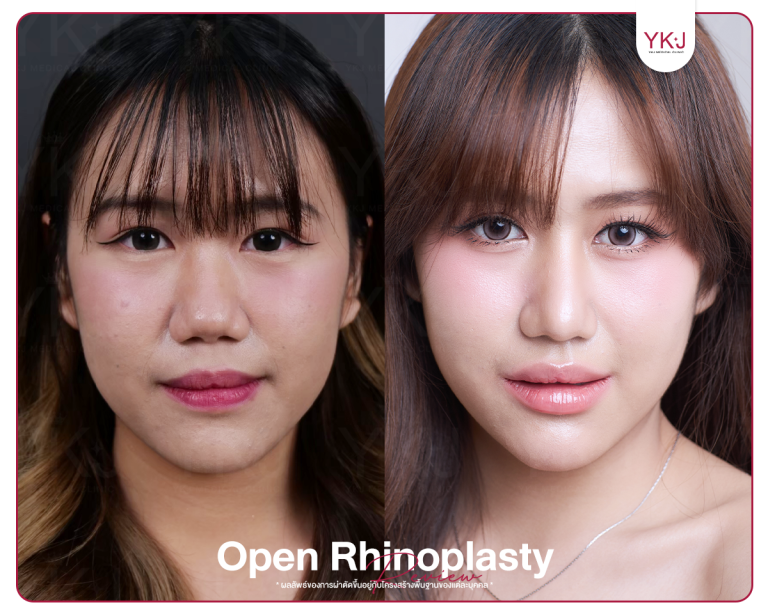 รีวิวแก้จมูก , รีวิวเสริมจมูกโอเพ่น , กระดูกซี่โครง , กระดูกอ่อนหลังหู