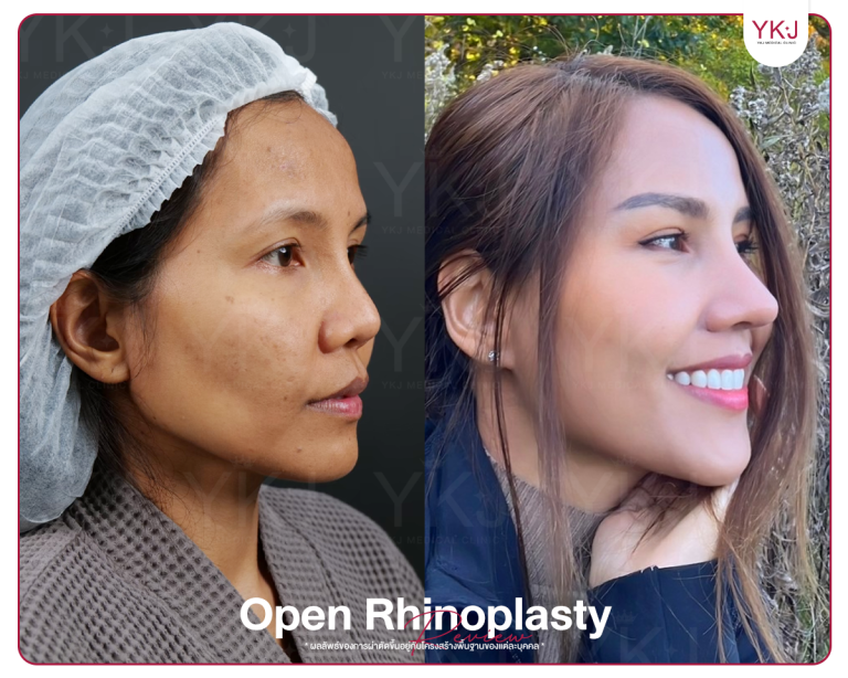 รีวิวแก้จมูก , รีวิวเสริมจมูกโอเพ่น , กระดูกซี่โครง , กระดูกอ่อนหลังหู