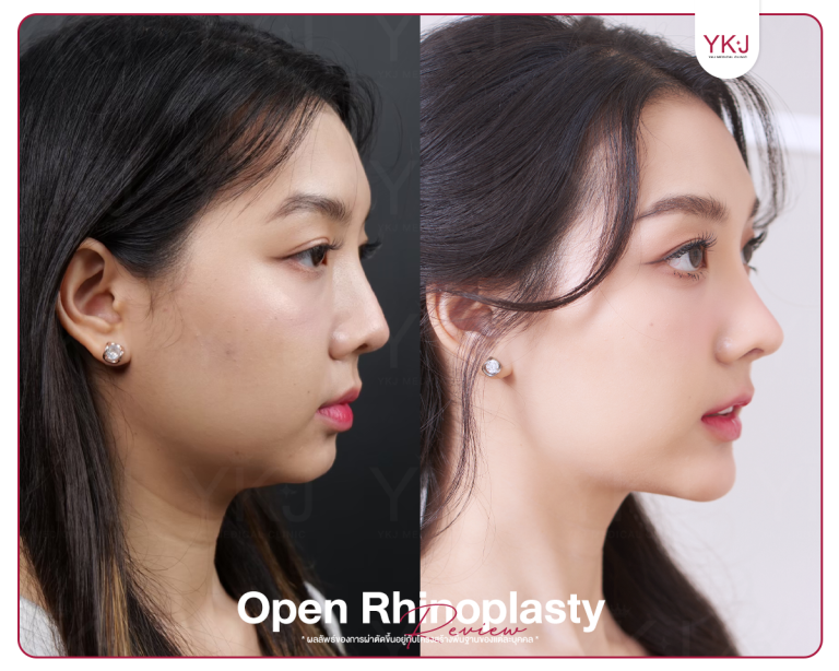 รีวิวแก้จมูก , รีวิวเสริมจมูกโอเพ่น , กระดูกซี่โครง , กระดูกอ่อนหลังหู