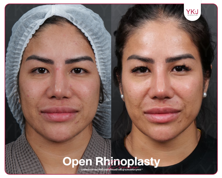 รีวิวแก้จมูก , รีวิวเสริมจมูกโอเพ่น , กระดูกซี่โครง , กระดูกอ่อนหลังหู