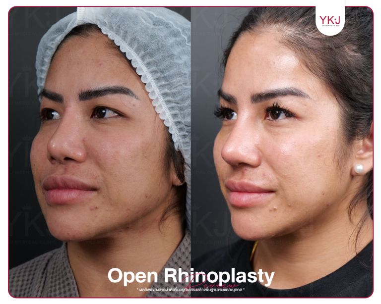 รีวิวแก้จมูก , รีวิวเสริมจมูกโอเพ่น , กระดูกซี่โครง , กระดูกอ่อนหลังหู