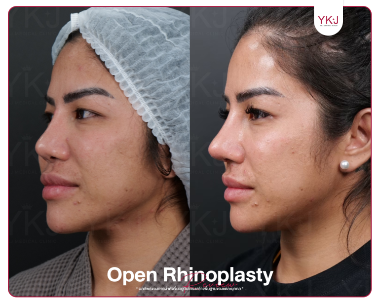 รีวิวแก้จมูก , รีวิวเสริมจมูกโอเพ่น , กระดูกซี่โครง , กระดูกอ่อนหลังหู