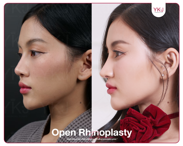 รีวิวแก้จมูก , รีวิวเสริมจมูกโอเพ่น , กระดูกซี่โครง , กระดูกอ่อนหลังหู