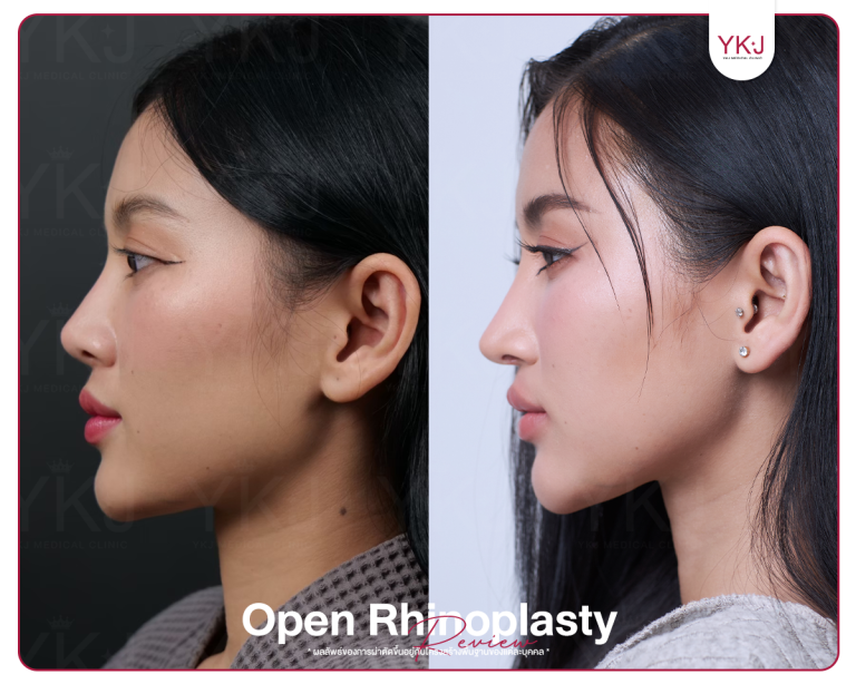 รีวิวแก้จมูก , รีวิวเสริมจมูกโอเพ่น , กระดูกซี่โครง , กระดูกอ่อนหลังหู