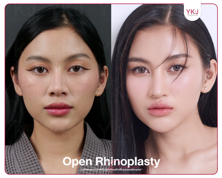 รีวิวแก้จมูก , รีวิวเสริมจมูกโอเพ่น , กระดูกซี่โครง , กระดูกอ่อนหลังหู