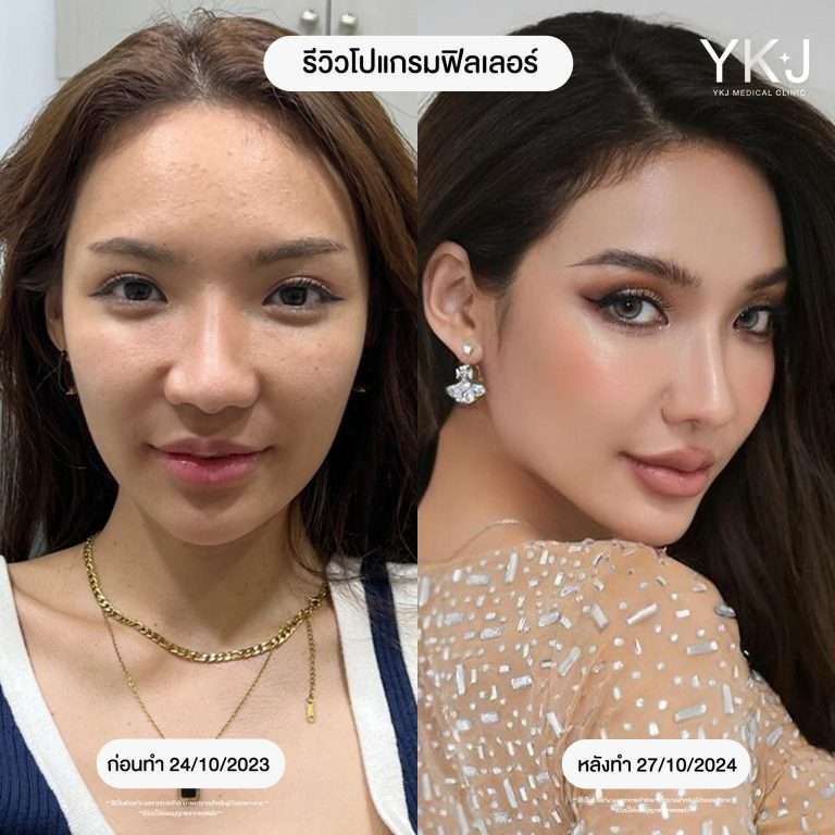 ฟิลเลอร์-filler