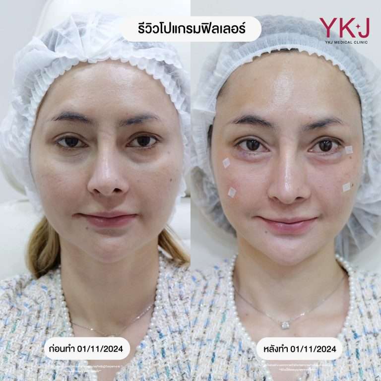 ฟิลเลอร์-filler