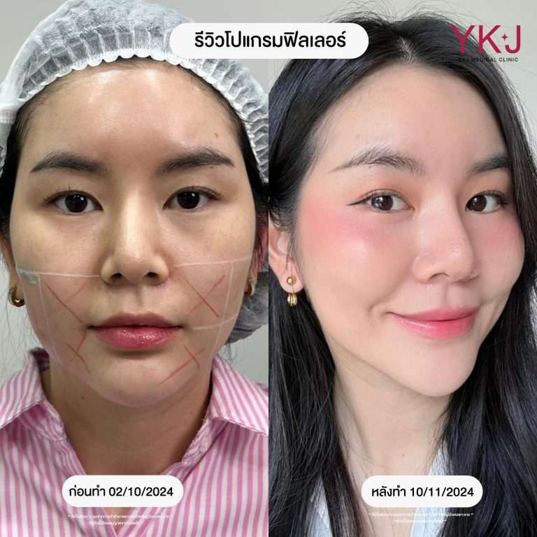 ฟิลเลอร์-filler
