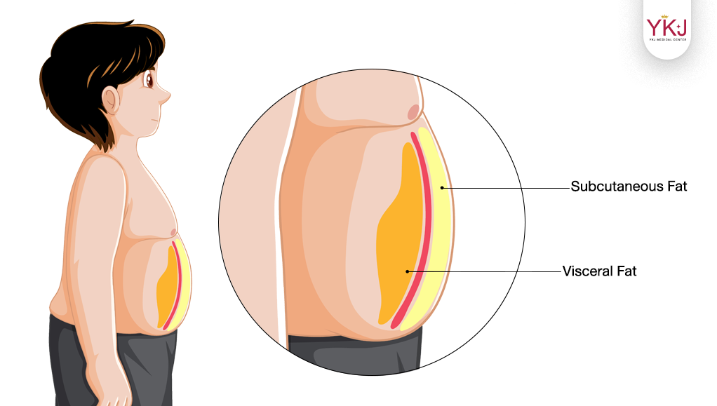 ดูดไขมัน-Liposuction