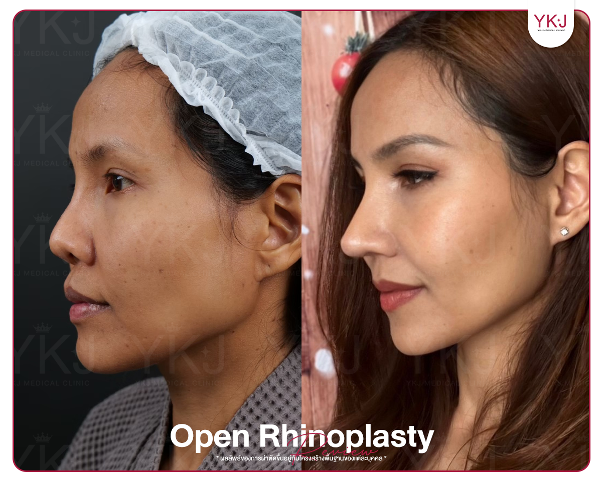 รีวิวแก้จมูก , รีวิวเสริมจมูกโอเพ่น , กระดูกซี่โครง , กระดูกอ่อนหลังหู รีวิวแก้จมูก , รีวิวเสริมจมูกโอเพ่น , กระดูกซี่โครง , กระดูกอ่อนหลังหู