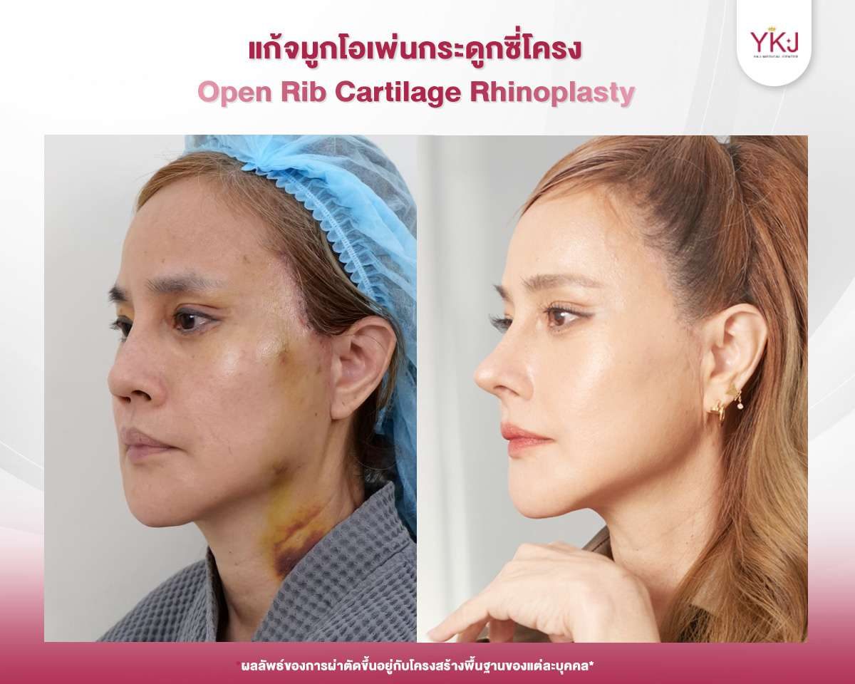 รีวิวเสริมจมูกโอเพ่น-แก้จมูก-001 รีวิวแก้จมูก , รีวิวเสริมจมูกโอเพ่น , กระดูกซี่โครง
