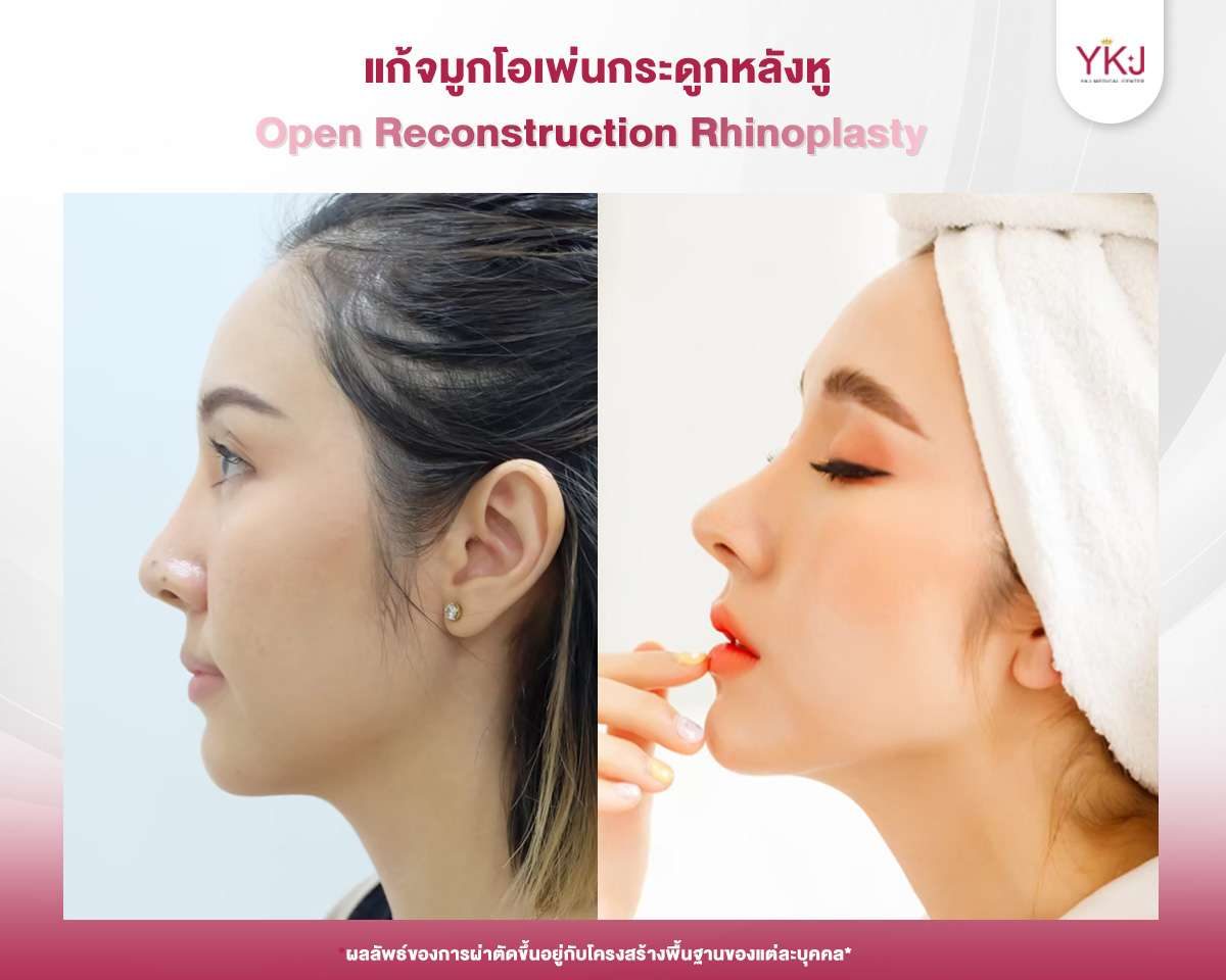 รีวิวเสริมจมูกโอเพ่น-แก้จมูก-046 รีวิวแก้จมูก , รีวิวเสริมจมูกโอเพ่น , กระดูกอ่อนหลังหู